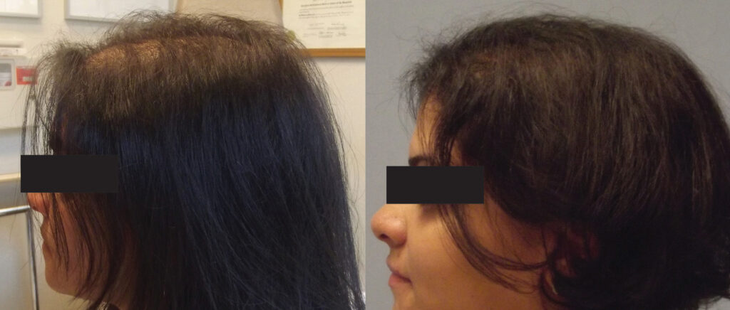 Hair Transplant before and after photo by Elite Dermatology & The Oaks Plastic Surgery in Houston TX