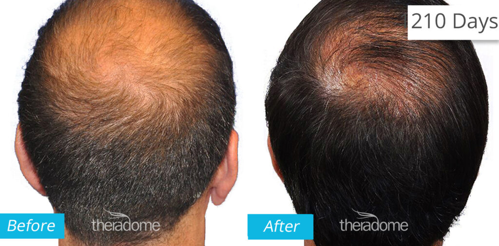 Non Surgical Treatments before and after photo by Elite Dermatology & The Oaks Plastic Surgery in Houston TX