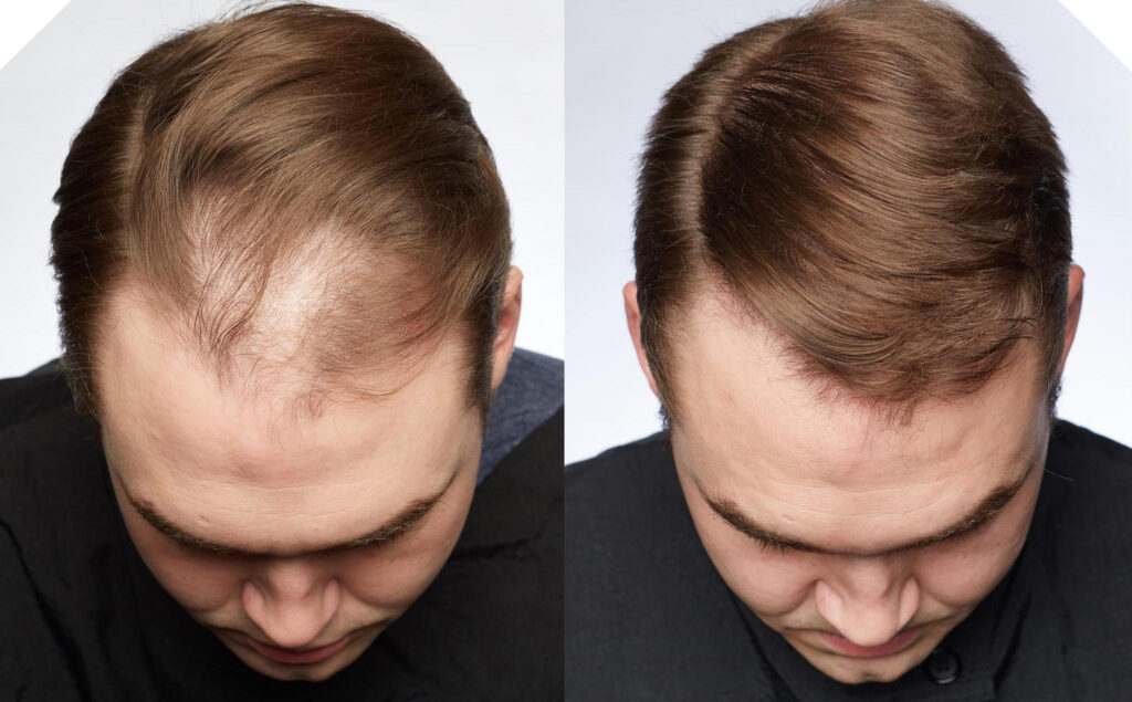 Non Surgical Treatments before and after photo by Elite Dermatology & The Oaks Plastic Surgery in Houston TX