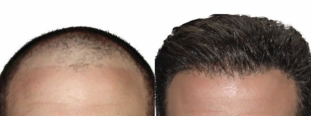 Hair Transplant before and after photo by Elite Dermatology & The Oaks Plastic Surgery in Houston TX