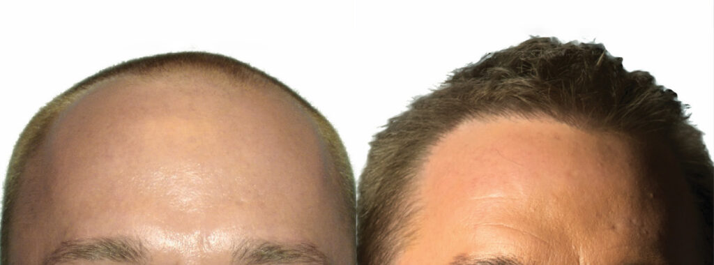 Hair Transplant before and after photo by Elite Dermatology & The Oaks Plastic Surgery in Houston TX