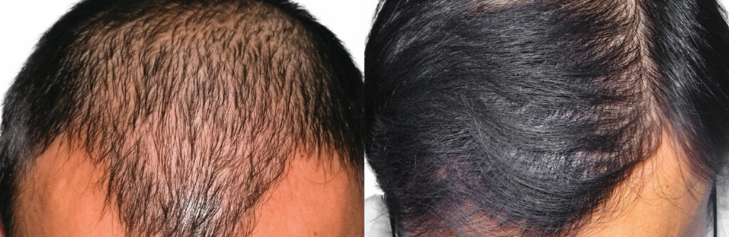 Hair Transplant before and after photo by Elite Dermatology & The Oaks Plastic Surgery in Houston TX