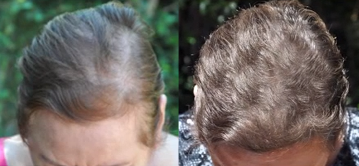 Non Surgical Treatments before and after photo by Elite Dermatology & The Oaks Plastic Surgery in Houston TX