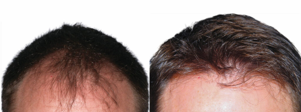 Hair Transplant before and after photo by Elite Dermatology & The Oaks Plastic Surgery in Houston TX
