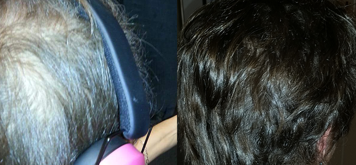 Non Surgical Treatments before and after photo by Elite Dermatology & The Oaks Plastic Surgery in Houston TX