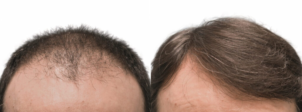 Hair Transplant before and after photo by Elite Dermatology & The Oaks Plastic Surgery in Houston TX