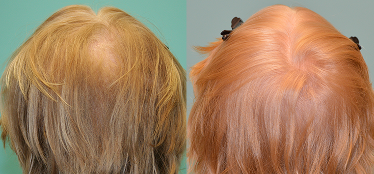 Non Surgical Treatments before and after photo by Elite Dermatology & The Oaks Plastic Surgery in Houston TX