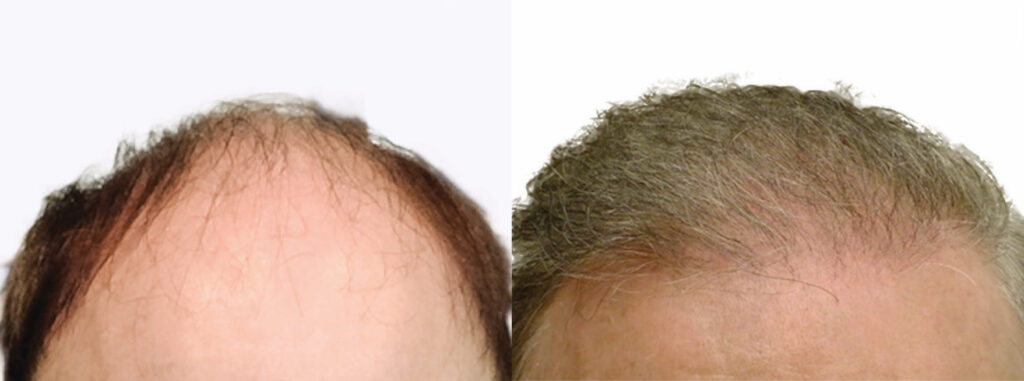 Hair Transplant before and after photo by Elite Dermatology & The Oaks Plastic Surgery in Houston TX