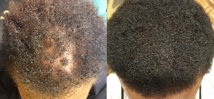 Non Surgical Treatments before and after photo by Elite Dermatology & The Oaks Plastic Surgery in Houston TX