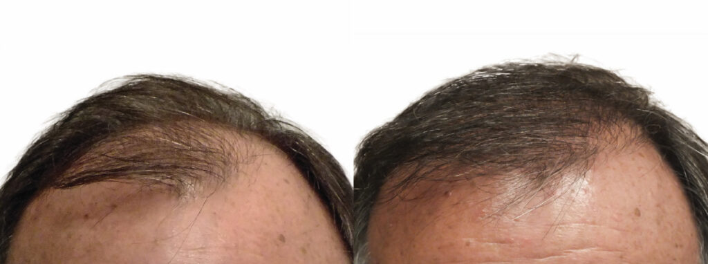 Hair Transplant before and after photo by Elite Dermatology & The Oaks Plastic Surgery in Houston TX