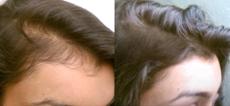 Non Surgical Treatments before and after photo by Elite Dermatology & The Oaks Plastic Surgery in Houston TX