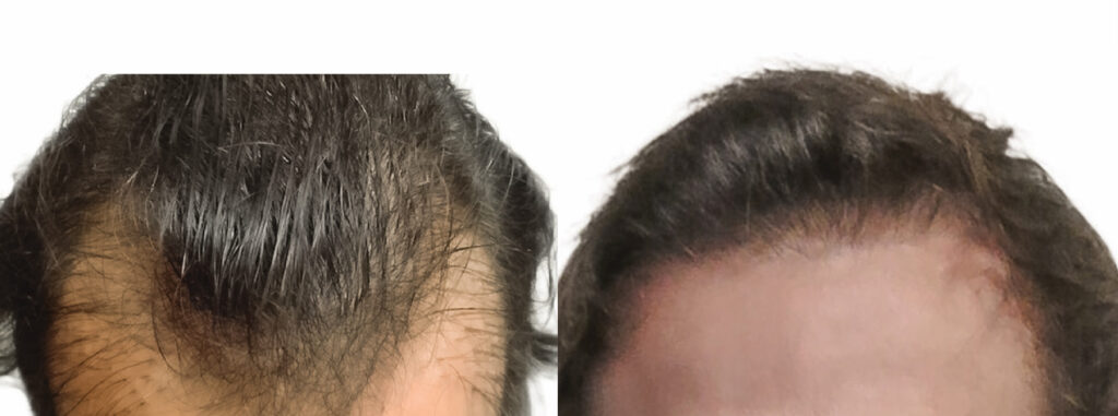 Hair Transplant before and after photo by Elite Dermatology & The Oaks Plastic Surgery in Houston TX
