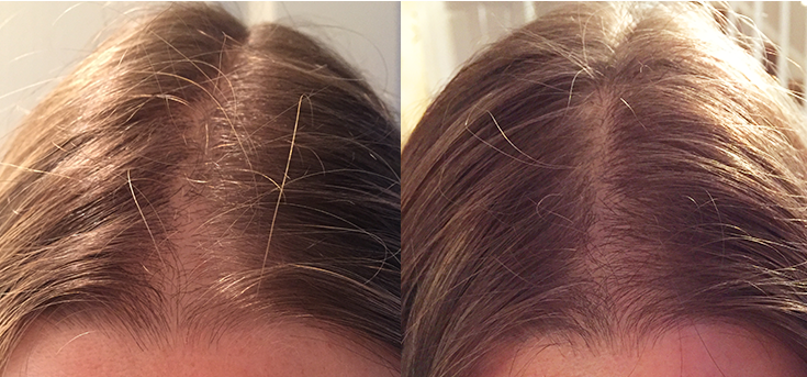 Non Surgical Treatments before and after photo by Elite Dermatology & The Oaks Plastic Surgery in Houston TX