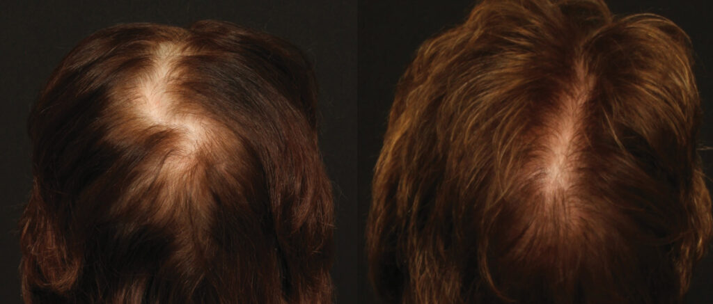 Hair Transplant before and after photo by Elite Dermatology & The Oaks Plastic Surgery in Houston TX