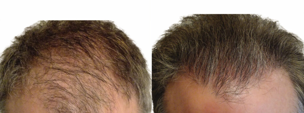 Hair Transplant before and after photo by Elite Dermatology & The Oaks Plastic Surgery in Houston TX