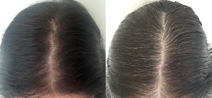 Non Surgical Treatments before and after photo by Elite Dermatology & The Oaks Plastic Surgery in Houston TX