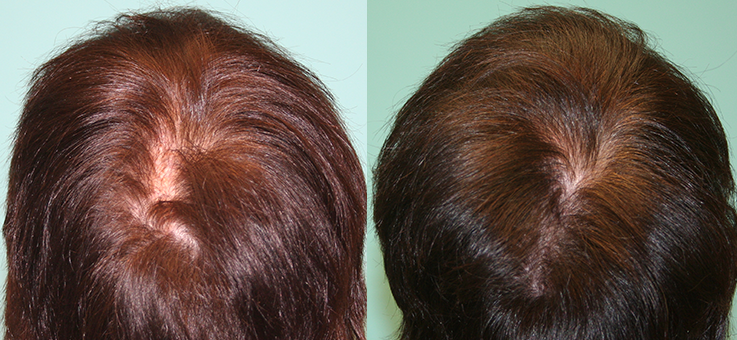 Non Surgical Treatments before and after photo by Elite Dermatology & The Oaks Plastic Surgery in Houston TX