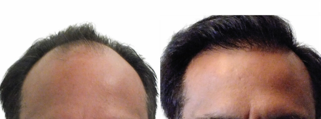 Hair Transplant before and after photo by Elite Dermatology & The Oaks Plastic Surgery in Houston TX