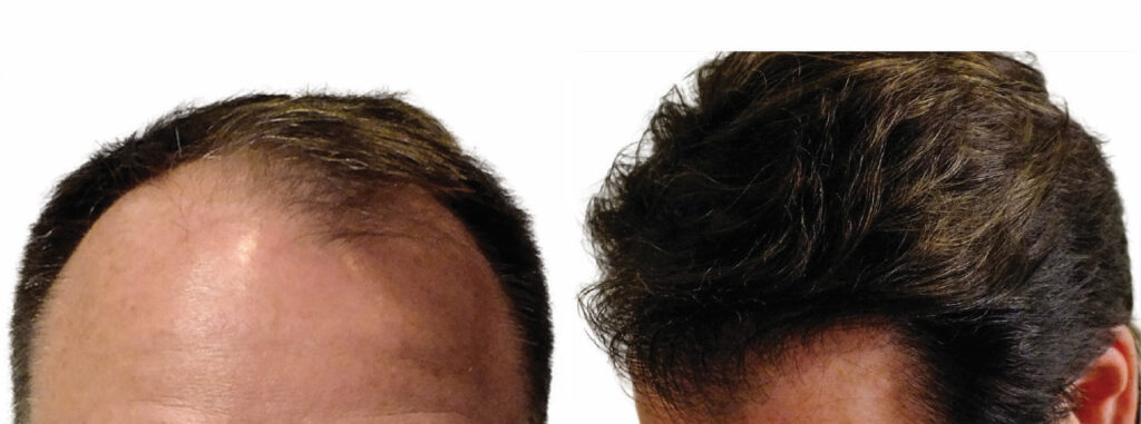 Hair Transplant before and after photo by Elite Dermatology & The Oaks Plastic Surgery in Houston TX
