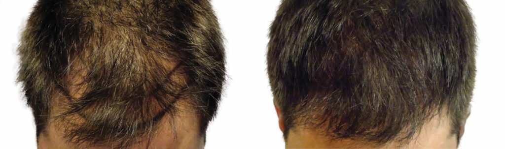 Hair Transplant before and after photo by Elite Dermatology & The Oaks Plastic Surgery in Houston TX