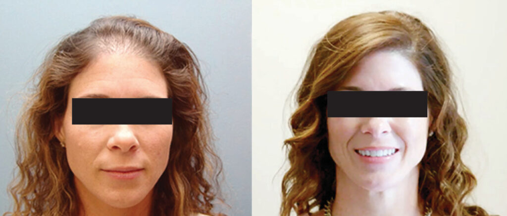 Hair Transplant before and after photo by Elite Dermatology & The Oaks Plastic Surgery in Houston TX