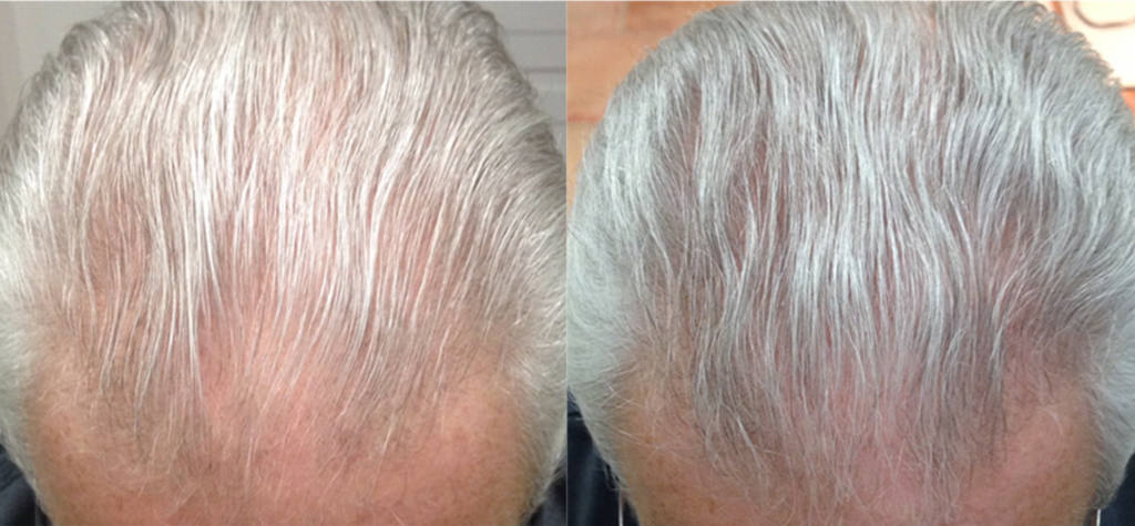 Non Surgical Treatments before and after photo by Elite Dermatology & The Oaks Plastic Surgery in Houston TX