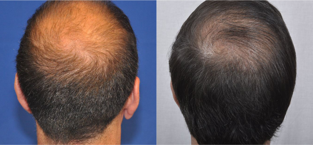 Non Surgical Treatments before and after photo by Elite Dermatology & The Oaks Plastic Surgery in Houston TX