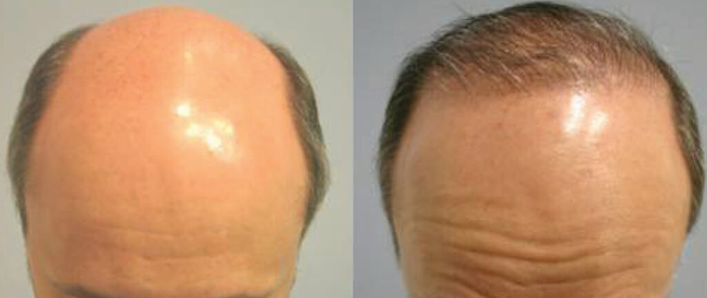 Hair Transplant before and after photo by Elite Dermatology & The Oaks Plastic Surgery in Houston TX
