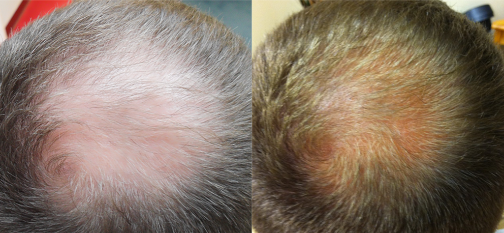 Non Surgical Treatments before and after photo by Elite Dermatology & The Oaks Plastic Surgery in Houston TX