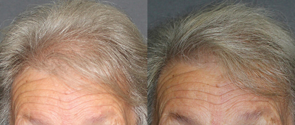 Hair Transplant before and after photo by Elite Dermatology & The Oaks Plastic Surgery in Houston TX