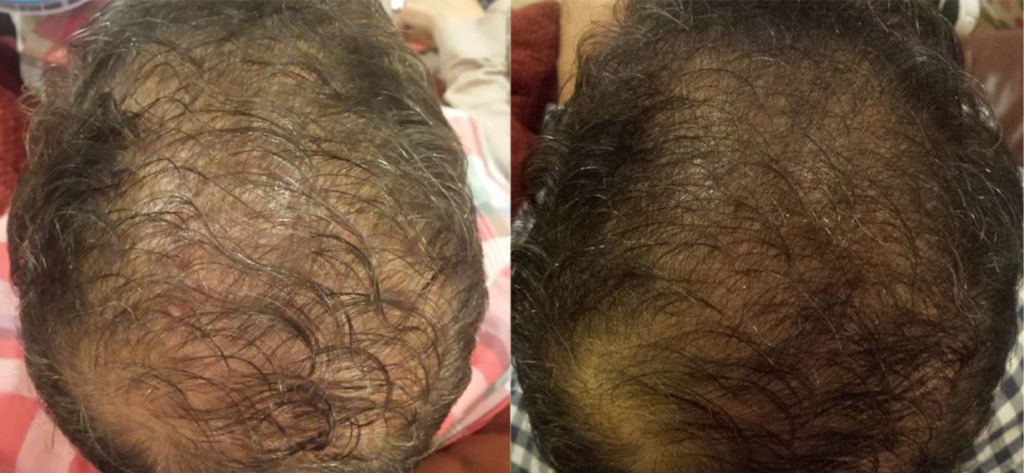 Non Surgical Treatments before and after photo by Elite Dermatology & The Oaks Plastic Surgery in Houston TX