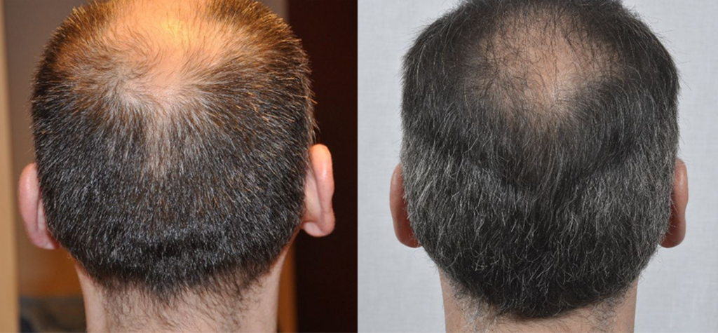 Non Surgical Treatments before and after photo by Elite Dermatology & The Oaks Plastic Surgery in Houston TX