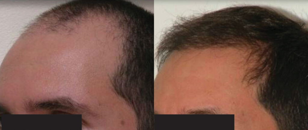 Hair Transplant before and after photo by Elite Dermatology & The Oaks Plastic Surgery in Houston TX