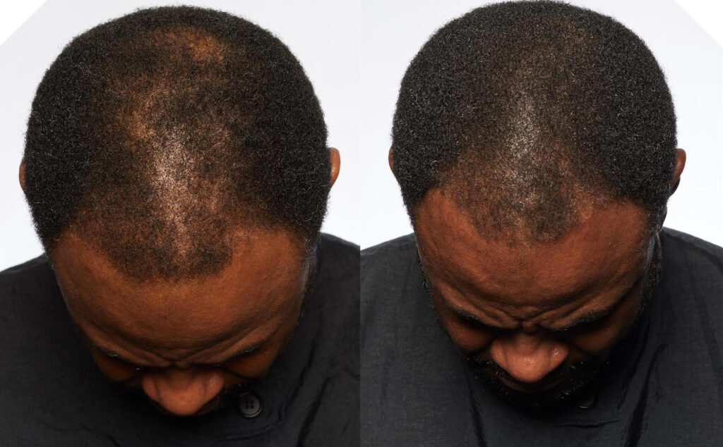 Non Surgical Treatments before and after photo by Elite Dermatology & The Oaks Plastic Surgery in Houston TX