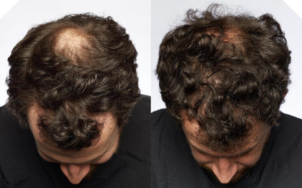 Non Surgical Treatments before and after photo by Elite Dermatology & The Oaks Plastic Surgery in Houston TX