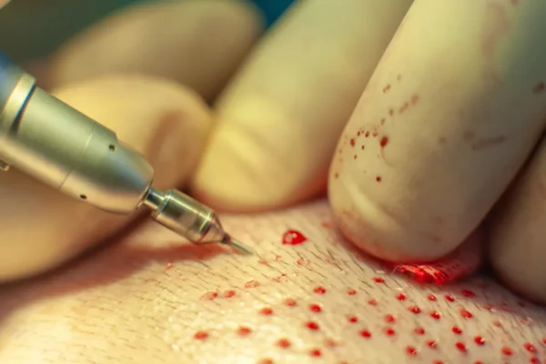 Patients head close up. Baldness treatment