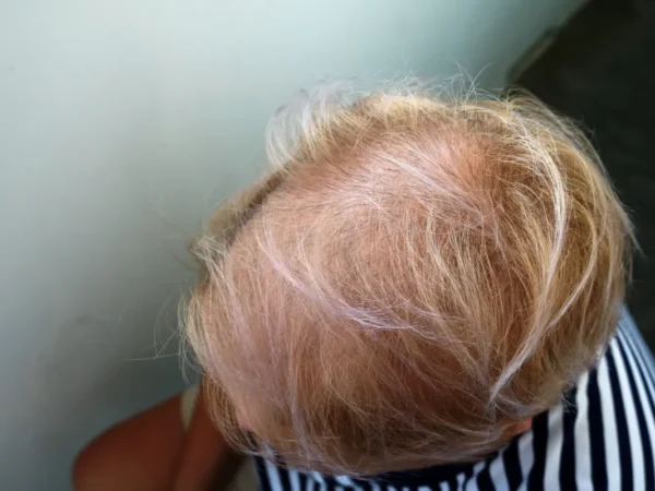 advanced hair loss female