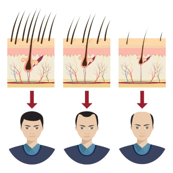 hair miniaturization cartoon