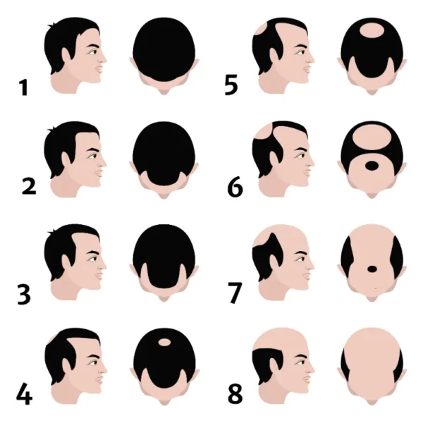 hamilton norwood scale