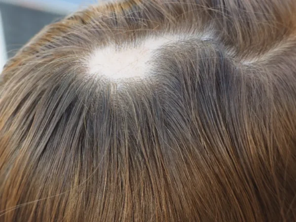 single patch lichen on the head