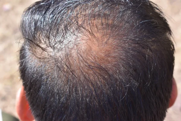 vertexcrown balding